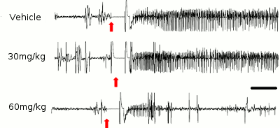 Amygdala seizures